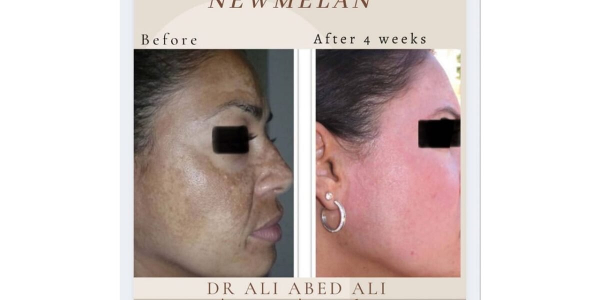 newmelan pigmentation الحل الأنسب لمعالجة تصبّغات الوجه مدى الحياة حديث مع دكتور التجميل ali abedali - صورة مميزة صورة مميزة: newmelan pigmentation الحل الأنسب لمعالجة تصبّغات الوجه مدى الحياة حديث مع دكتور التجميل ali abedali